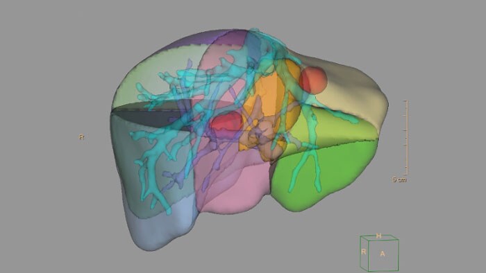 CT Liver Analysis