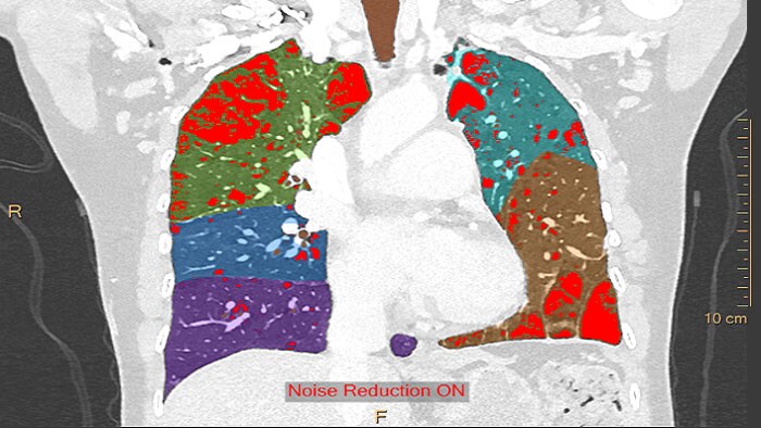 CT COPD image