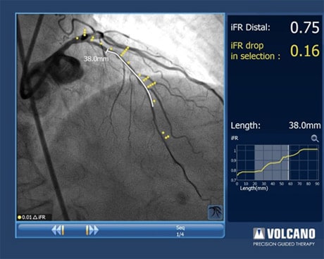 ifr coreg difuse disease