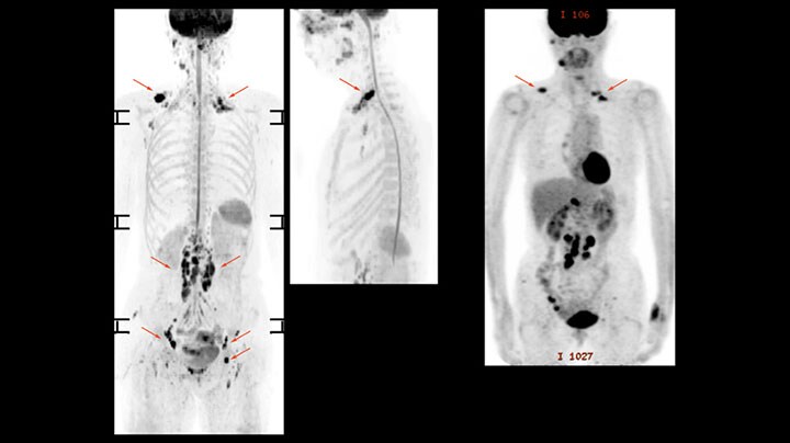 Diffusionsgewichtete Ganzkörper-MRT