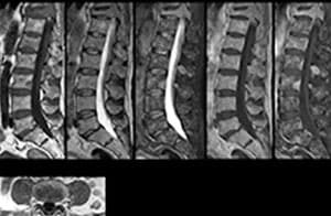 MR-Scan zur Ermittlung der Ursache für Rückenschmerzen​