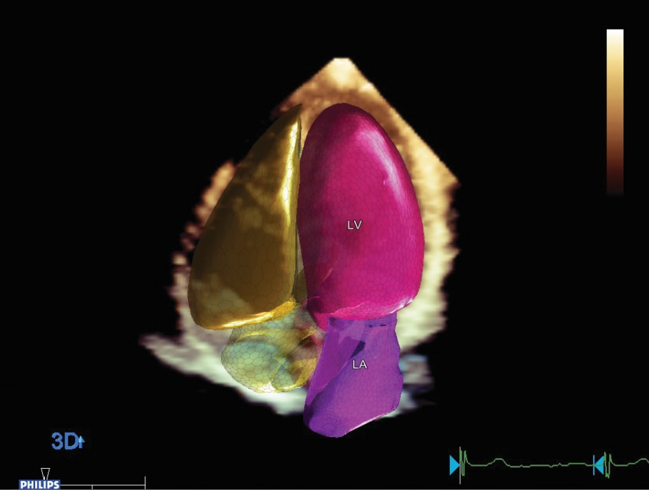 Dreidimensionale Echokardiographie der linken Herzklappe​
