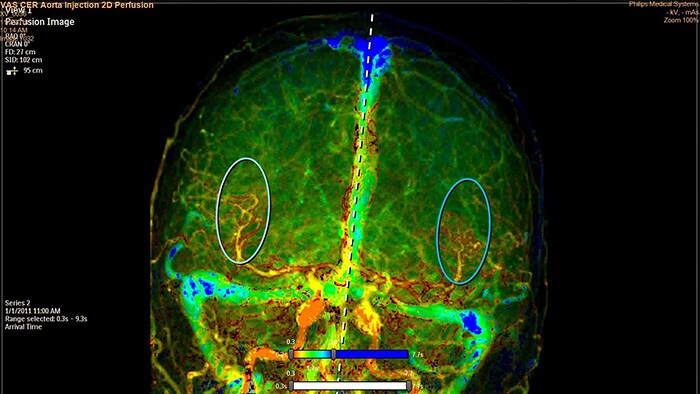 SmartPerfusion image