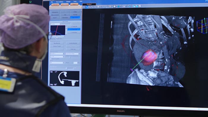 Tumorbiopsie und Tumorablation