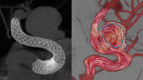 AneurysmFlow image