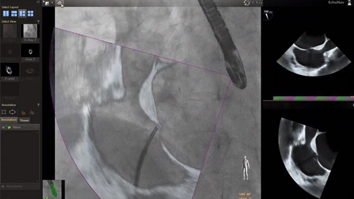 EchoNav Modelle Aorta Mitral