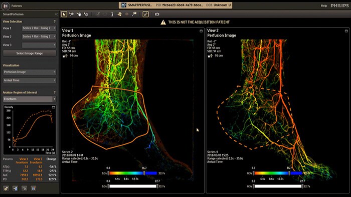 SmartPerfusion image