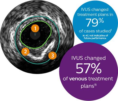 IVUS veränderte die Behandlung