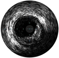 Digitale IVUS-Bildverarbeitung