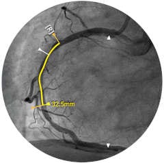 IntraSight iFR-Koregistrierung*