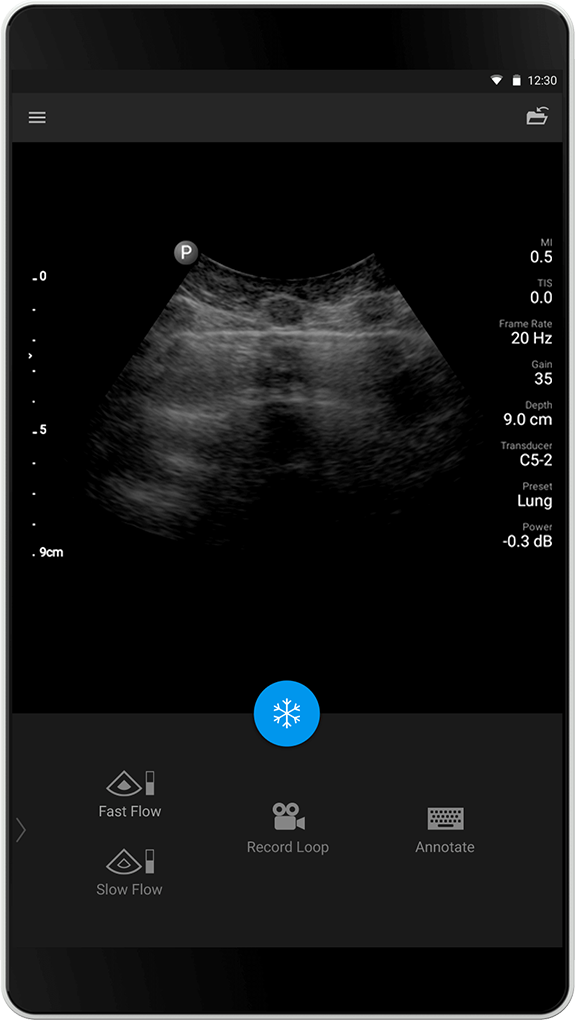 Lungenknoten C5-2