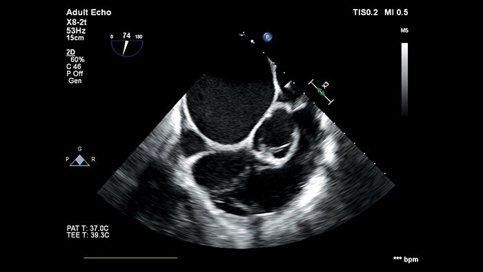 Diagnostische transthorakale und transösophageale 2D- und 3D-Schallköpfe