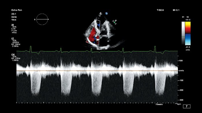 xmatrix transducers