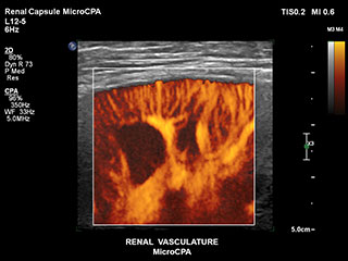 Nierenkapsel mit MCPA