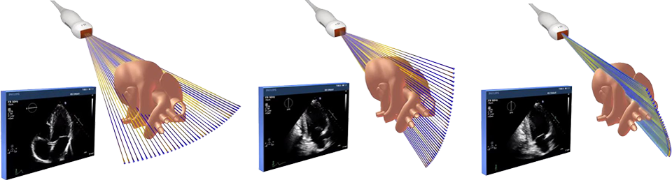 iRotate-Innovation im xMATRIX-Schallkopf zur Erstellung eines vollständigen Stressechoprotokoll