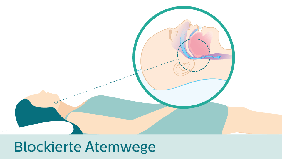 Wenn Sie in Rückenlage schlafen