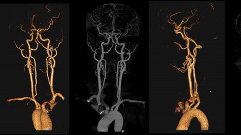 Philips Incisive CT Precise Suite