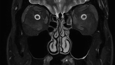 Klinisches Bild der Nasennebenhöhle mit SmartSpeed Precise auf dem MR 5300 System