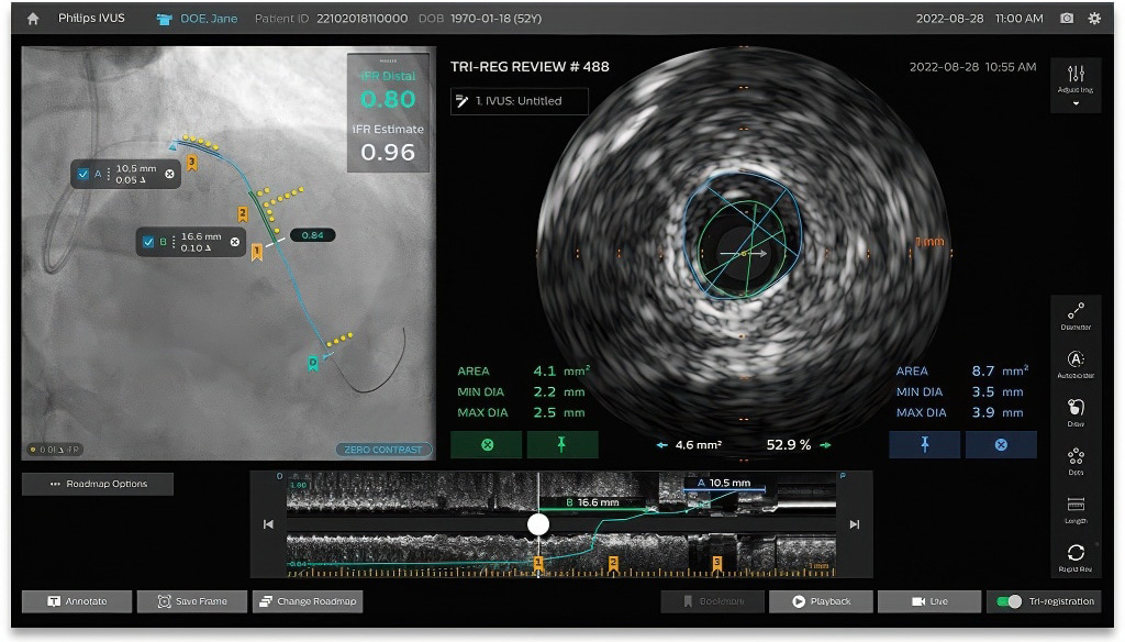 Tri-Registrierung am neuen IntraSight plus 
